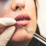 Photo of woman's face from nose down, with a filler needle approaching her lips.